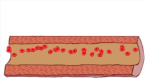 Self-Assessment of Blood Stasis Constitution: Not Only Must Blood Stasis Be Activated and Resolved, But Qi Must Also Be Nourished