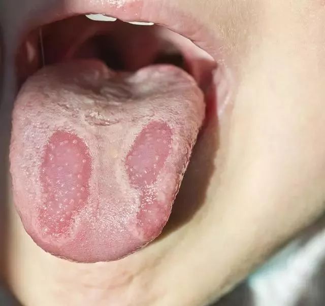 Tongue Diagnosis in Traditional Chinese Medicine: Observing Tongue Color, Shape, State, and Coating