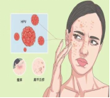 Fire Needle Therapy: A Unique Tool of Traditional Chinese Medicine