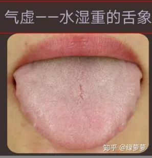 Qi Deficiency Constitution: Tongue Manifestations of Dampness and Methods for Regulation