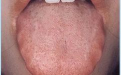 Traditional Chinese Medicine Tongue Diagnosis - Tongue Coating