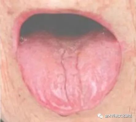 Tongue Diagnosis in Traditional Chinese Medicine: Tongue Coating
