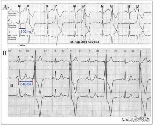Understanding Pulse Patterns: Xu Mai, Wei Mai, Xi Mai, Dai Mai, and Duan Mai Explained for Everyone