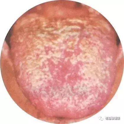 Learn Quick Ways to Observe Tongue Quality and Coating to Understand Your Health and Diseases!