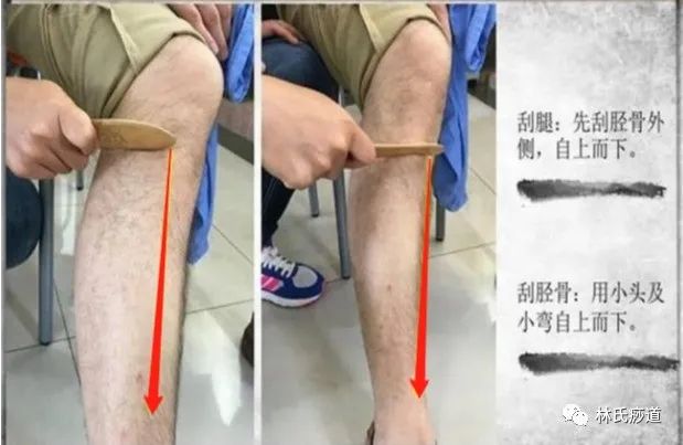 Key Points of Gua Sha
