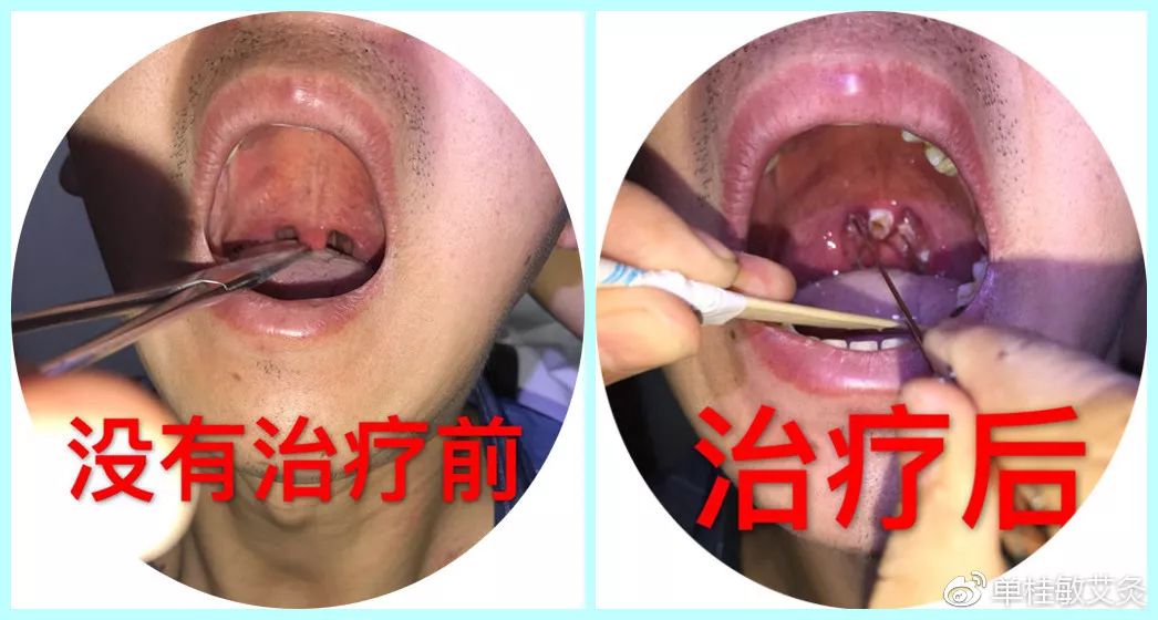 Fire Needle Therapy for Pharyngitis and Enlarged Uvula