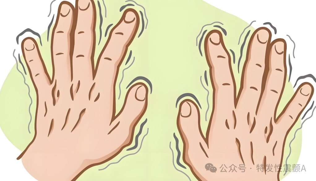 Numbness in Hands and Feet of Patients with Essential Tremor? Deficiency of Qi and Blood, Blood Stasis? Sharing a Formula