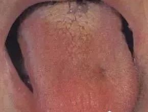 Understanding Tongue Diagnosis in Traditional Chinese Medicine (with Tongue Diagnosis Illustrations)