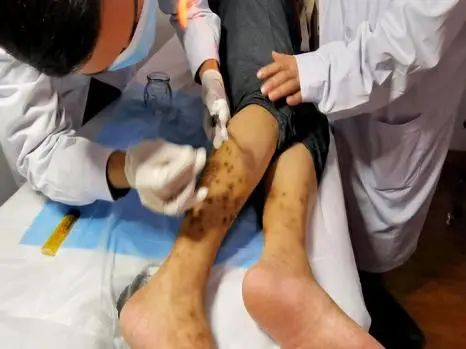 Acupuncture Department II: What Conditions Can Fire Needle Therapy Treat?