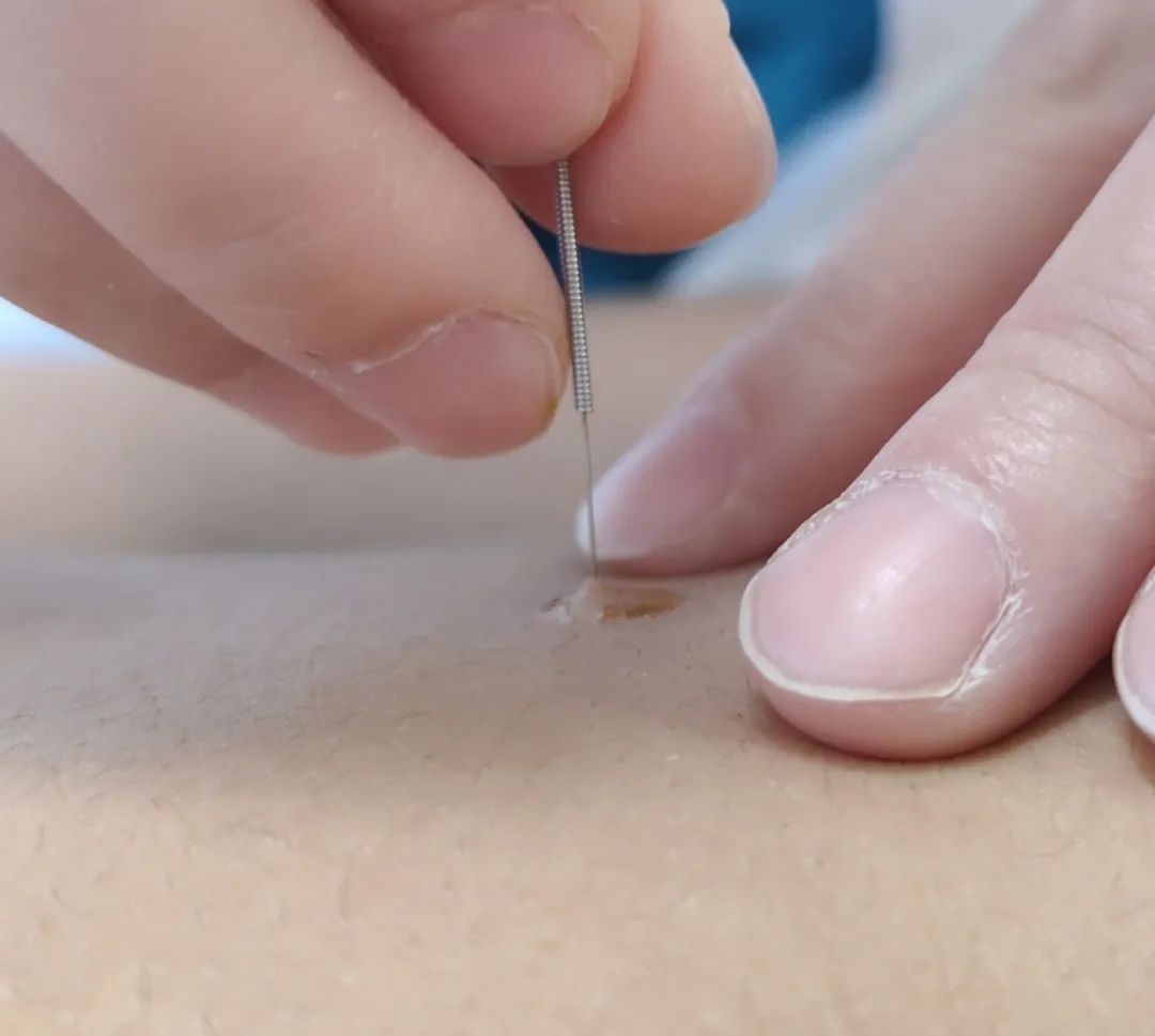Understanding Dampness in Traditional Chinese Medicine: Effective Methods to Eliminate Dampness