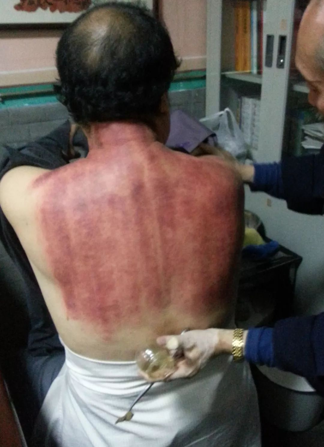 Pediatric Gua Sha: A Traditional Approach to Child Health