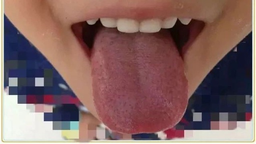 Tongue Diagnosis: Warning Signs of Spleen Yin Deficiency in Children with Thin Build and Pale Complexion