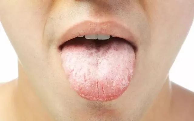 Tongue Diagnosis in Traditional Chinese Medicine: Observing Tongue Color, Shape, State, and Coating