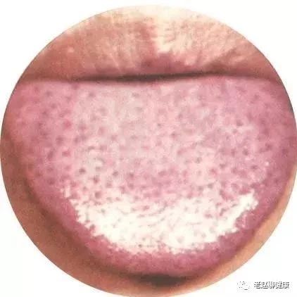 Learn Quick Ways to Observe Tongue Quality and Coating to Understand Your Health and Diseases!