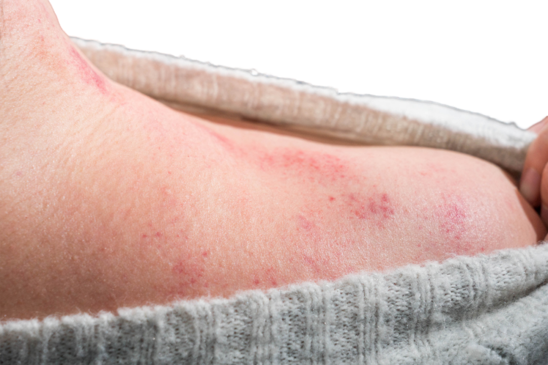 Gua Sha: A Gentle Scraping Technique to Regulate Qi and Blood, Boost Immunity!