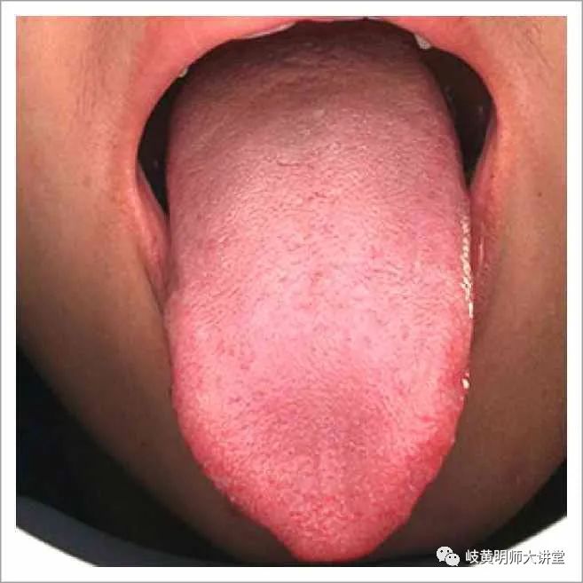Traditional Chinese Medicine Tongue Diagnosis: Illustrated Guide to 14 Types of Tongue Shapes and Qualities