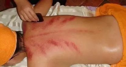 The Eight Most Common Techniques of Gua Sha and Comprehensive Analysis of Sha Patterns