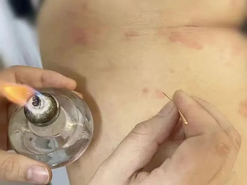 Fire Needle Therapy in Traditional Chinese Medicine for Treating Folliculitis, Boils, and Abscesses