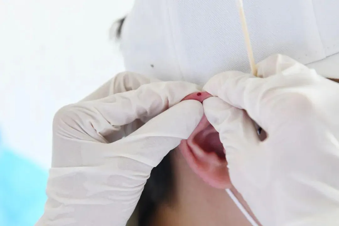 Ear Apex Bloodletting Therapy in Traditional Chinese Medicine
