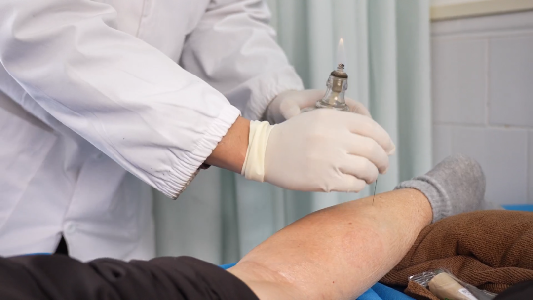 Exploring the Efficacy of Lingnan Fire Needle Therapy in Traditional Chinese Medicine