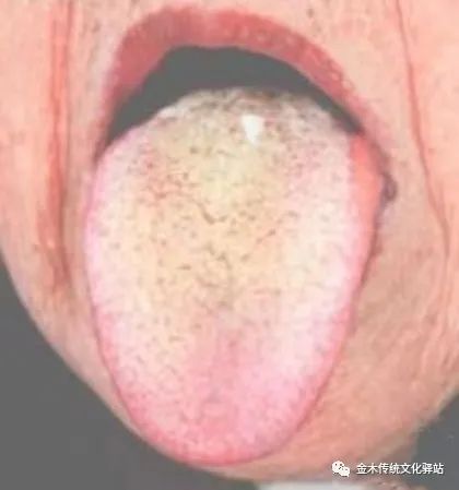Tongue Diagnosis in Traditional Chinese Medicine: Tongue Coating