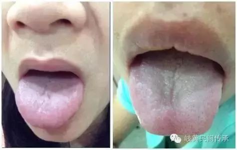 Understanding Your Body Constitution Through Tongue Coating Observation