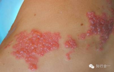Shingles Pain: The Remarkable Efficacy of Fire Needle Therapy