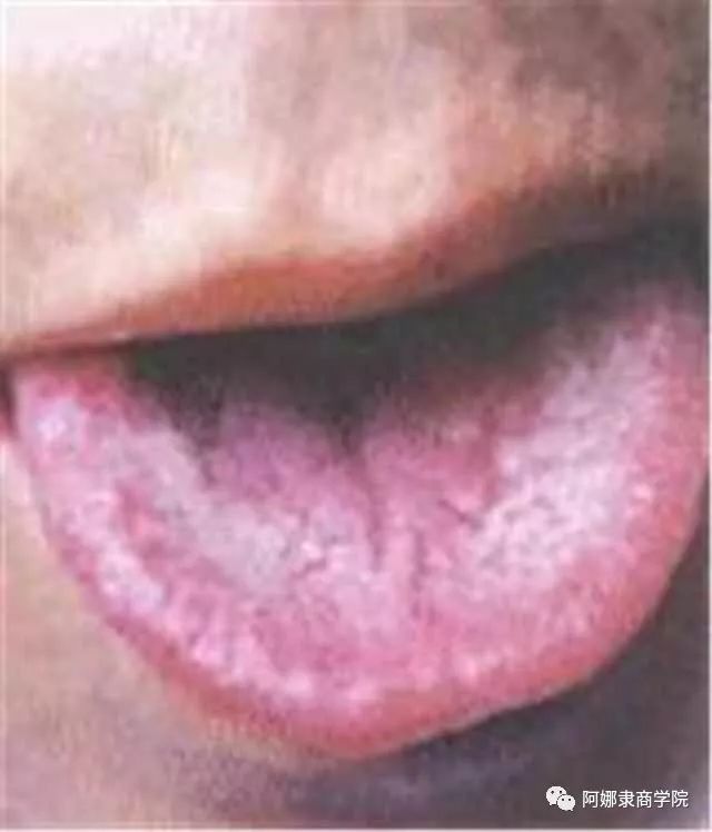 A Comprehensive Guide to 22 High-Definition Tongue Diagnosis Images: Understand Diseases Through Tongue Observation!