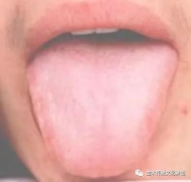 Tongue Diagnosis in Traditional Chinese Medicine: Characteristics of Tongue Coating
