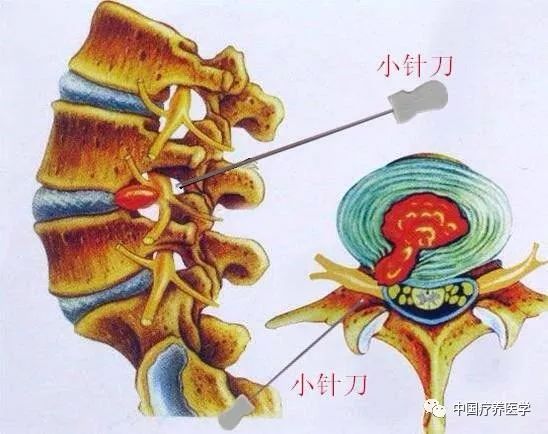 What Diseases Can Be Treated with Fire Needle and Needle Knife Therapy?