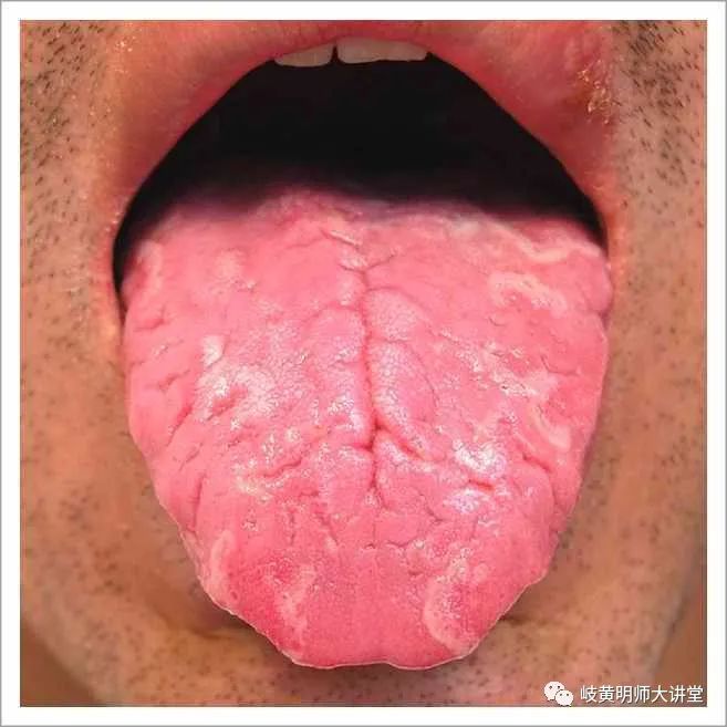 Traditional Chinese Medicine Tongue Diagnosis: Illustrated Guide to 14 Types of Tongue Shapes and Qualities