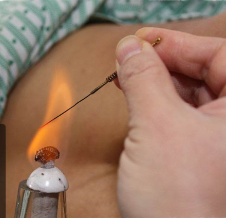 Acupuncture Specialty Treatment - Fire Needle