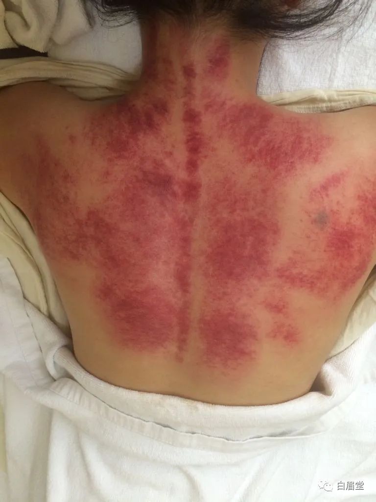 The Origins, Techniques, and Precautions of Gua Sha (Gua Sha: A Localized Method to Improve Circulation, Delay Aging, Promote Qi and Blood Flow, and Alleviate Pain)