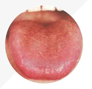 Understanding Tongue Diagnosis in TCM: Insights into Health from Tongue Appearance (Part 2)