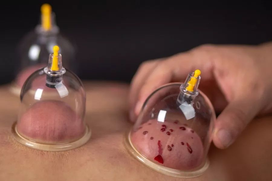Definition and Functions of Bloodletting in Traditional Chinese Medicine