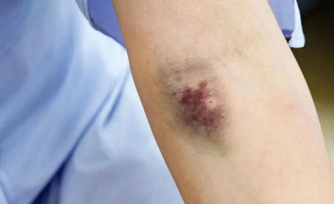 The Ultimate Method to Resolve Blood Stasis: Warming Yang and Smoothing the Liver! A Two-Step Approach from Traditional Chinese Medicine