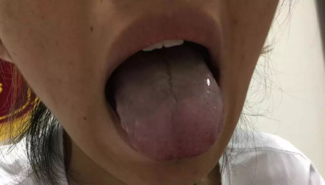 A Series on Tongue Diagnosis