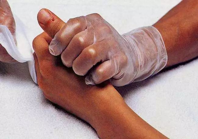 Bloodletting Therapy for 24 Difficult Diseases: A Unique TCM Approach