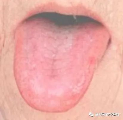 Tongue Diagnosis in Traditional Chinese Medicine: Characteristics of Tongue Coating