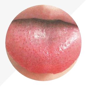 Understanding Tongue Diagnosis in TCM: Insights into Health from Tongue Appearance (Part 2)