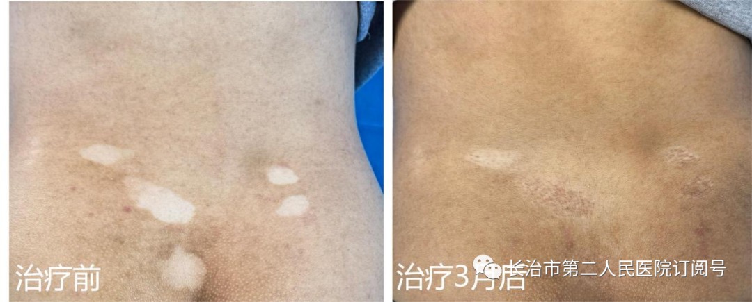 The Power of Fire Needling in Treating Skin Diseases