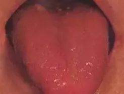 Understanding Tongue Diagnosis in Traditional Chinese Medicine (with Tongue Diagnosis Illustrations)