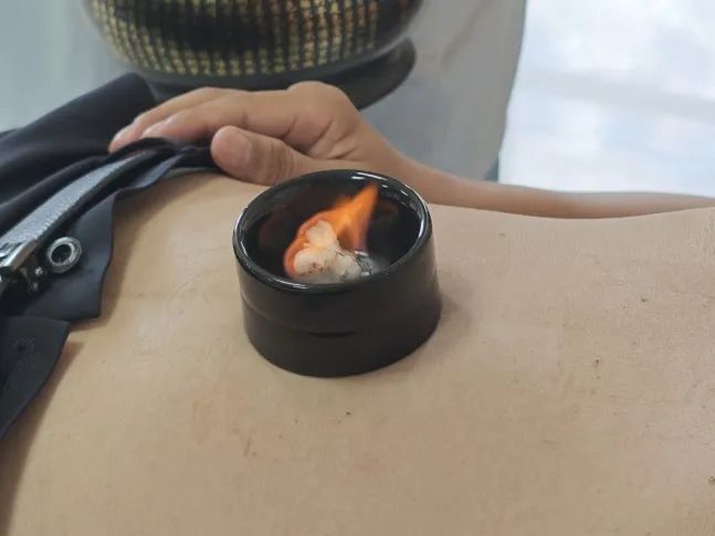Traditional Chinese Medicine Therapy: Warming Yang Cupping