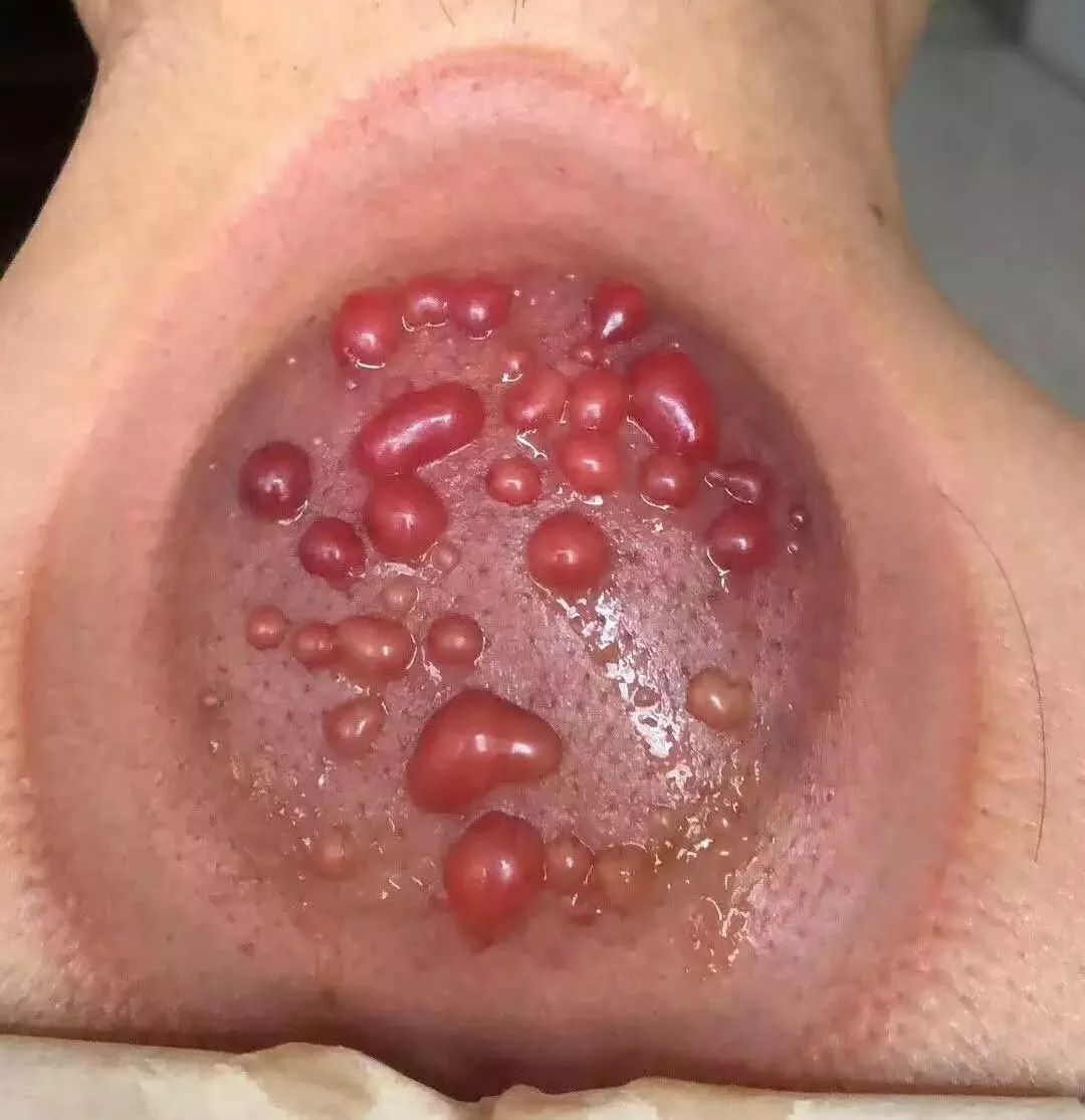What Do Cupping Marks Indicate After Treatment?