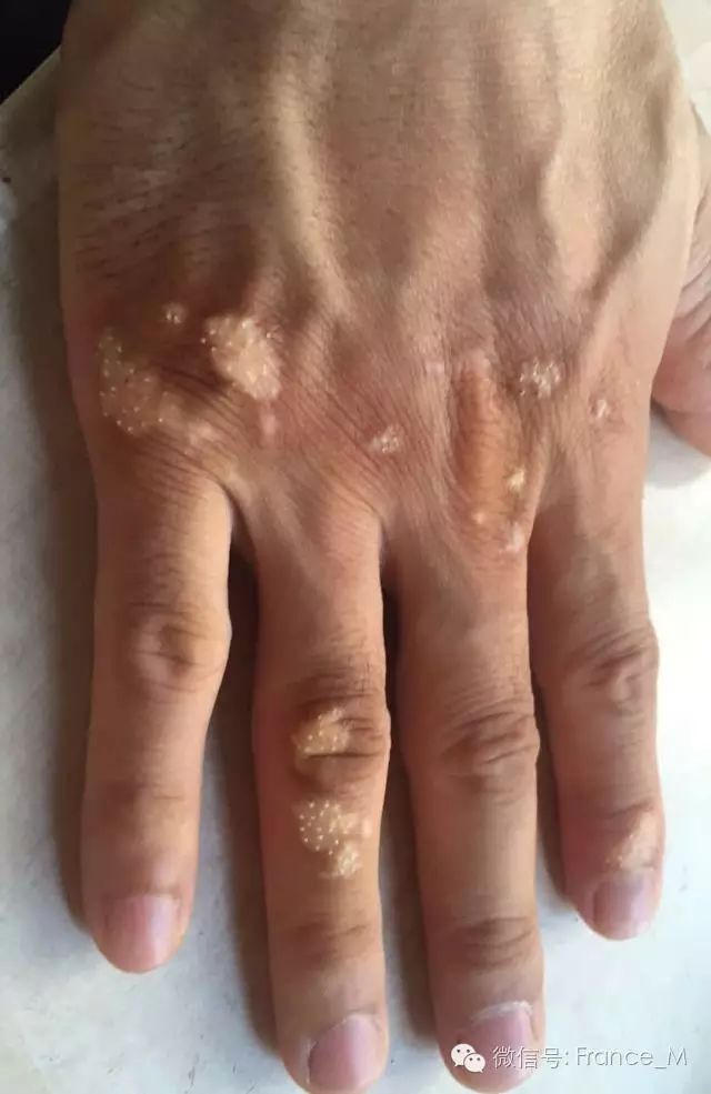 Fire Needle Therapy for Vitiligo