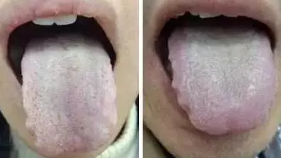 What Does Traditional Chinese Medicine Observe in the Tongue? Nine Body Types and Valuable Tongue Diagnosis Charts!
