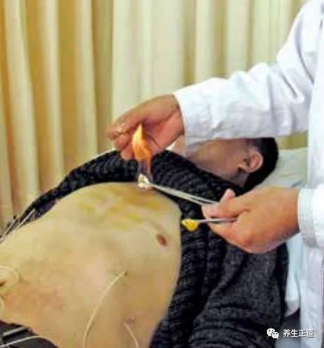 Traditional Chinese Medicine Acupuncture: The Art of Fire Needle Therapy