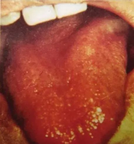 Comprehensive Guide to Tongue Diagnosis and Associated Conditions in TCM