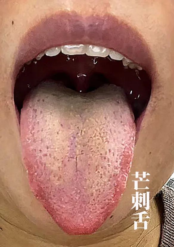 The Body Signals Illness: Understanding Tongue Diagnosis in TCM