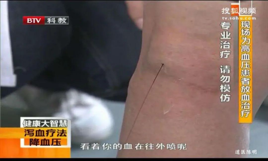 Bloodletting Therapy in Traditional Chinese Medicine: A Pathway to Healing
